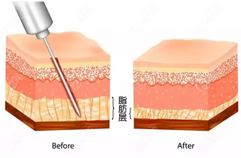 抽脂手術(shù)對(duì)身體有什么傷害？該不該禁止抽脂手術(shù)？